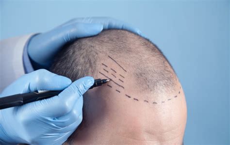 Haartransplantatie Behandelingen In Nederland