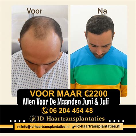 Haartransplantatie: De Juiste Aanpak Voor Jouw Haar