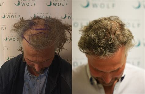 Haartransplantatie En De Economische Aspecten