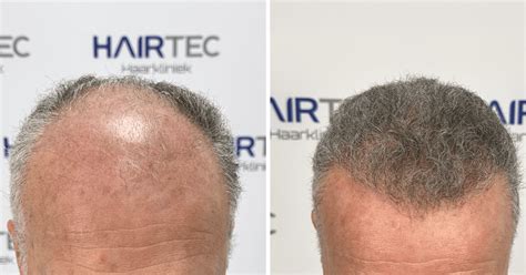 Haartransplantatie En Hoe Het Te Promoten