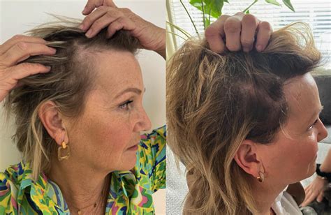 Haartransplantatie Na Zorg En Ondersteuning