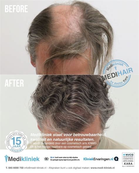 Natuurlijke Remedies Voor Haarverlies En Haartransplantatie